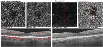 OCT vs. OCT-A: Assess retinal structure and function with advanced imaging technology 