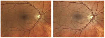 Case Study: Detection of Diabetic Macular Edema Despite Minimal Symptoms