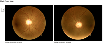 [OCT Observations] Optovue Solix Glaucoma Protocol #2 J.Rodman