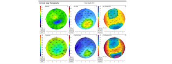 Case Study: Multiple Imaging Techniques to Detect Corneal Irregularities