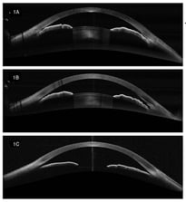 [OCT Observations] Utilizing Full-Range Anterior Chamber Scans in the Management of Glaucoma
