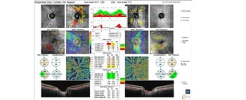 Case Study: OCT-A and Glaucoma