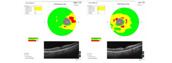 Case Study: Paracentral Acute Middle Maculopathy: Structural Recovery with Persistent Scotoma