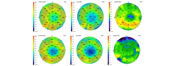 Case Study: Diagnosis and Treatment of Corneal HOA Utilizing Epithelial Compensation Mapping
