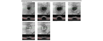 Case Study: Patient Resistant to Anti-VEGF