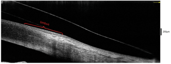 Case Study: Scleral Lens Simplicity: Utilizing Anterior Segment OCT for Scleral Lens Fitting