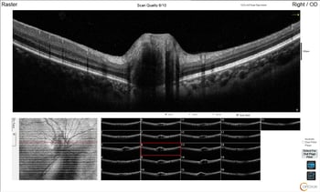 [OCT Article] Case Study: Advanced OCT Diagnostics for Buried Optic Nerve Head Drusen