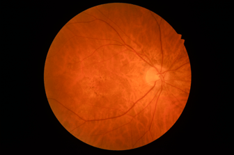 [OCT Article] Choroidal Neovascularization with Optovue Solix