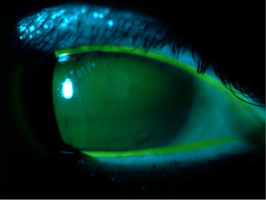 [OCT Artículo] Caso ojo seco y mapa de espesor epitelial irregular