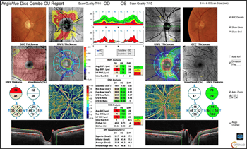 [OCT Articolo] Report completo per la gestione del glaucoma